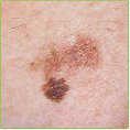 Melanoma maligno foto