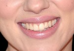 Dentes frontais não-saudáveis.