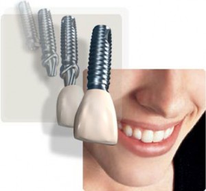 Qual o melhor implanta dentário. implante